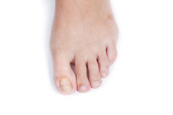 Toe Fungus