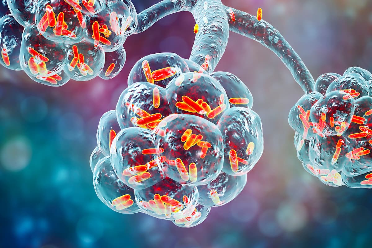 Bacterial pneumonia, medical concept. 3D illustration showing rod-shaped bacteria inside alveoli