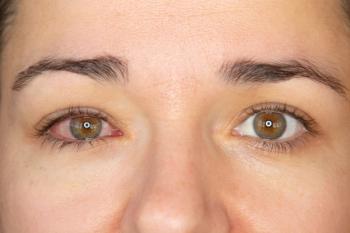 Close up of an adult woman having conjunctivitis | Image Credit: lavizzara - stock.adobe.com