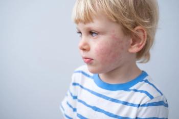 portrait of little boy with allergic rash or eczema on face. severe allergic reaction, atopic skin - Image credit: Юля Шевцова | stock.adobe.com