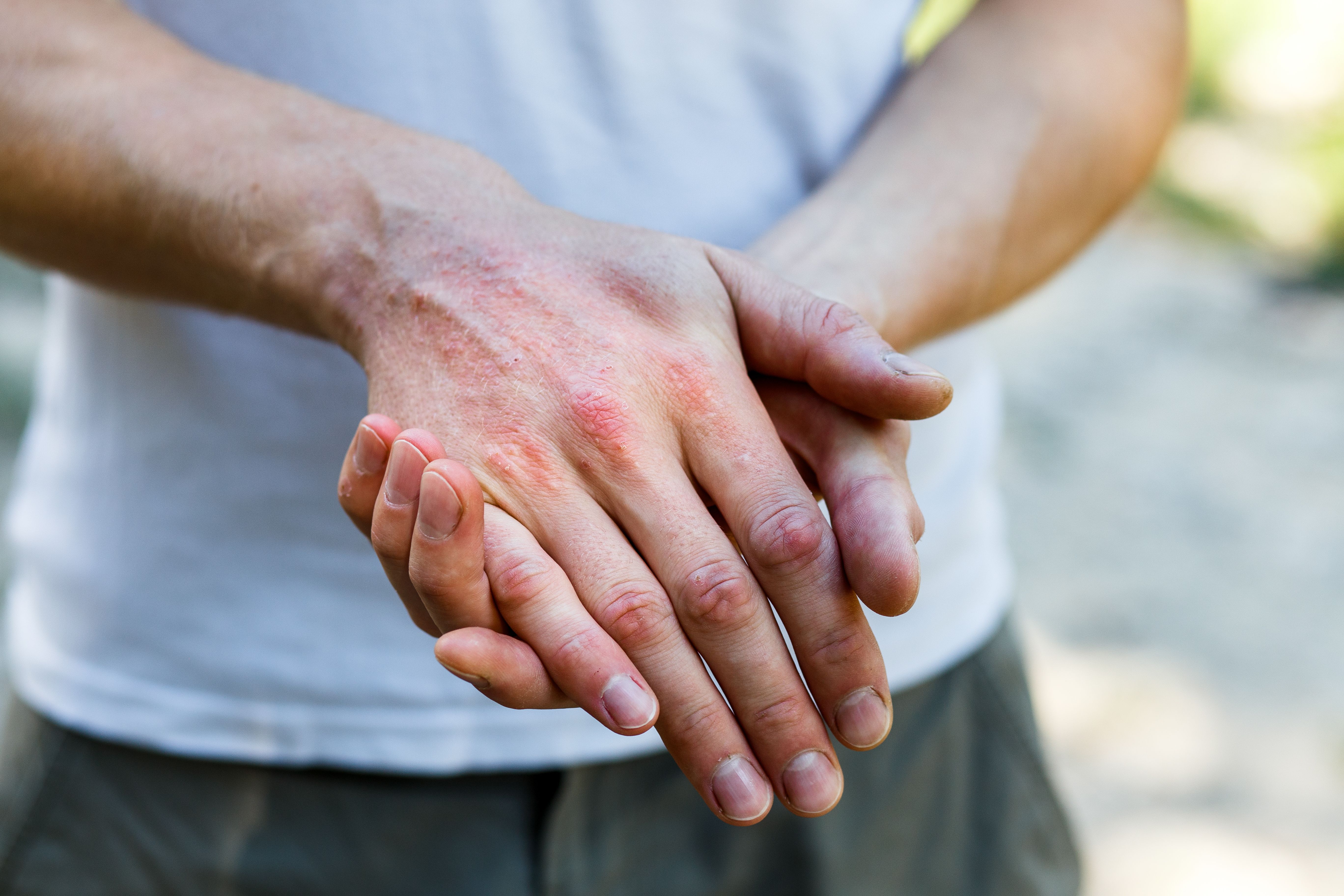 Close up dermatitis on skin, ill allergic rash eczema skin of patient , atopic dermatitis symptom skin detail texture , Fungus of skin ,The concept dermatology, treatment fungal. Man itching his hand - Image credit: Ольга Тернавская | stock.adobe.com