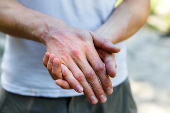 Close up dermatitis on skin, ill allergic rash eczema skin of patient , atopic dermatitis symptom skin detail texture , Fungus of skin ,The concept dermatology, treatment fungal. Man scratching his hand - Image credit: Ольга Тернавская | stock.adobe.com
