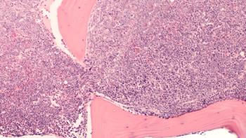 A staging bone marrow biopsy shows replacement of normal elements by diffuse large B-cell lymphoma, a type of non Hodgkin lymphoma