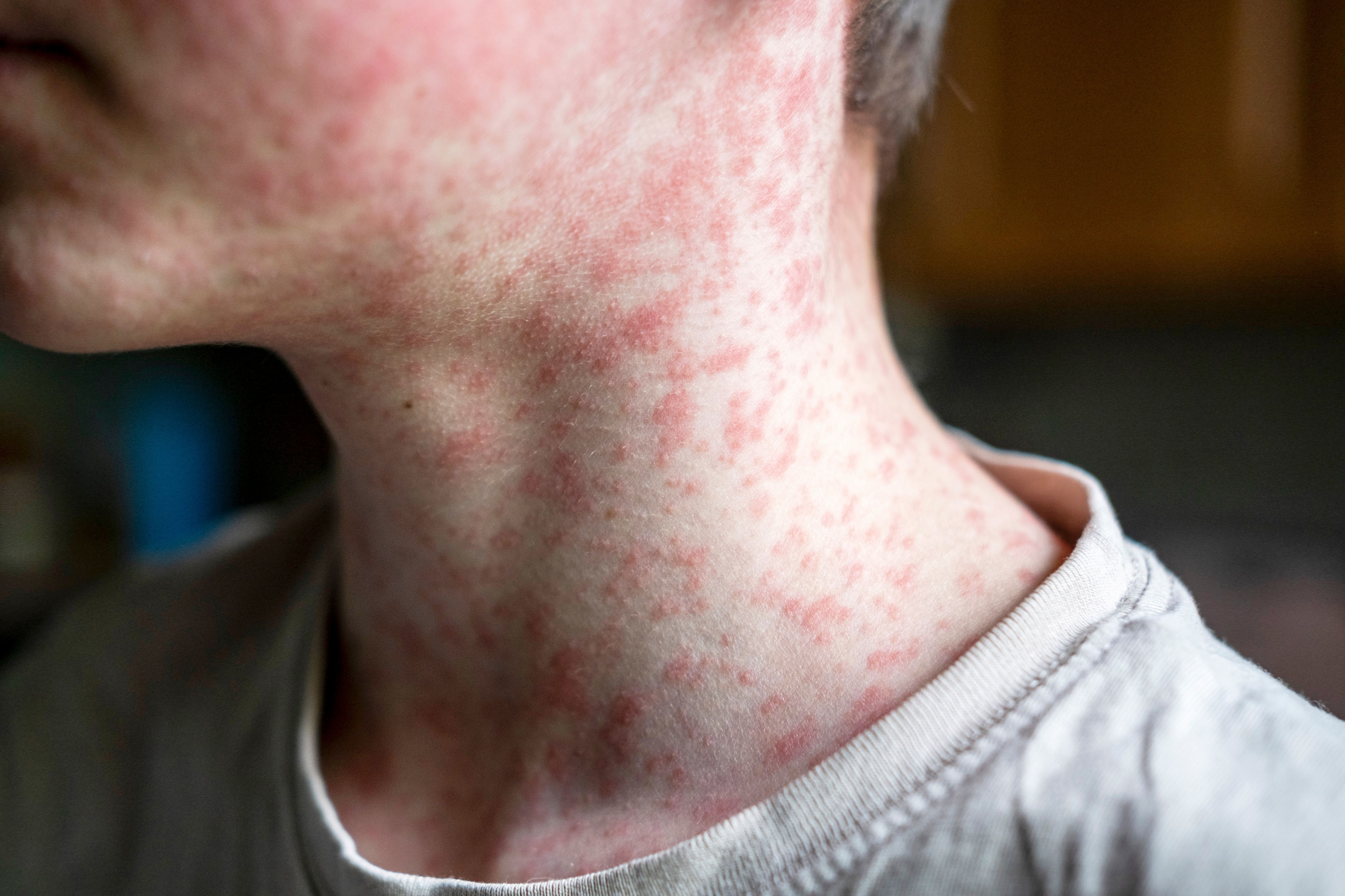 Measles viral disease, human skin covered with measles rash, vaccination concept - Image credit: Наталья Майшева | stock.adobe.com