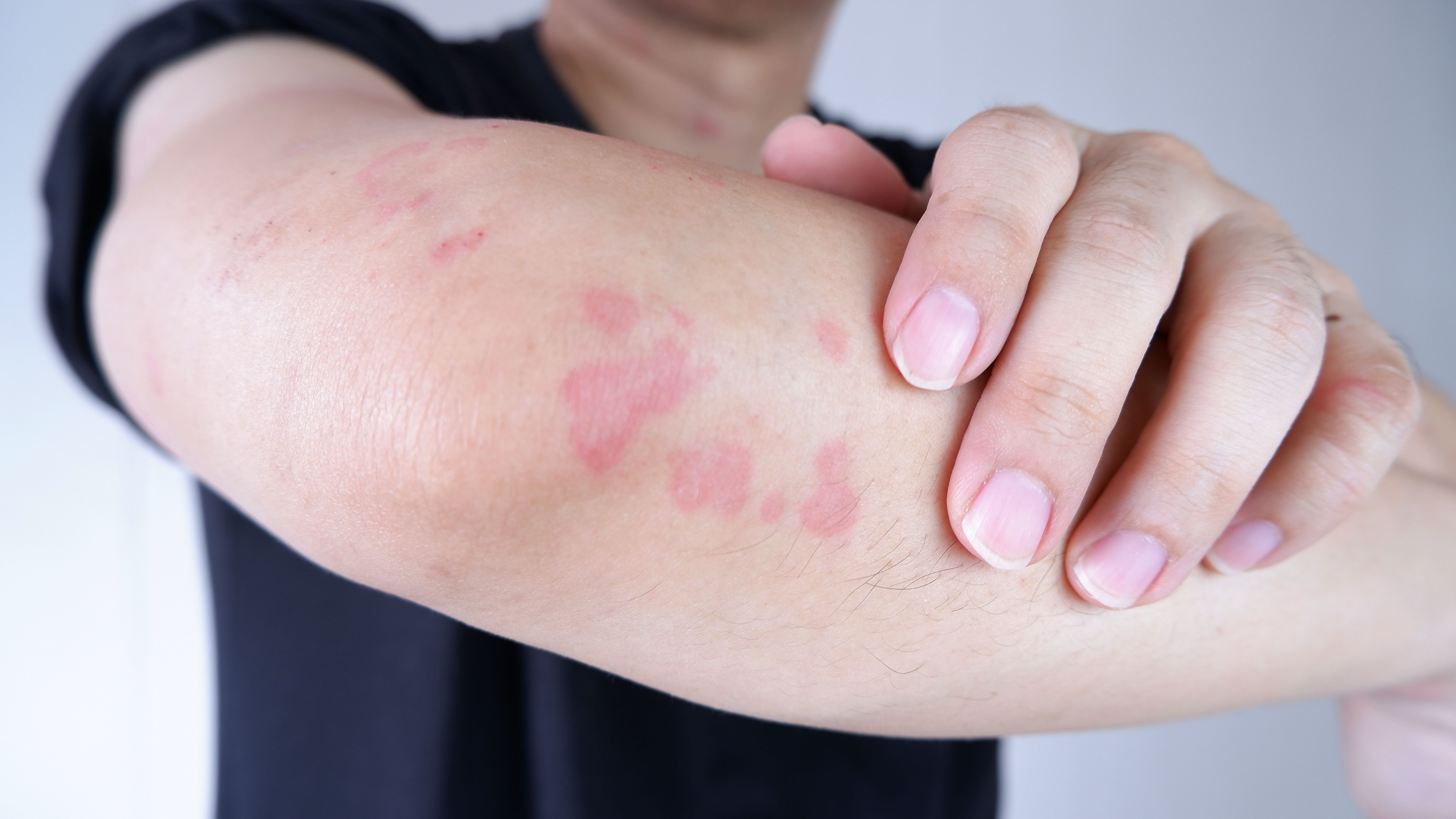 Patient with itchy hives (CSU) -- Image credit: wisely | stock.adobe.com