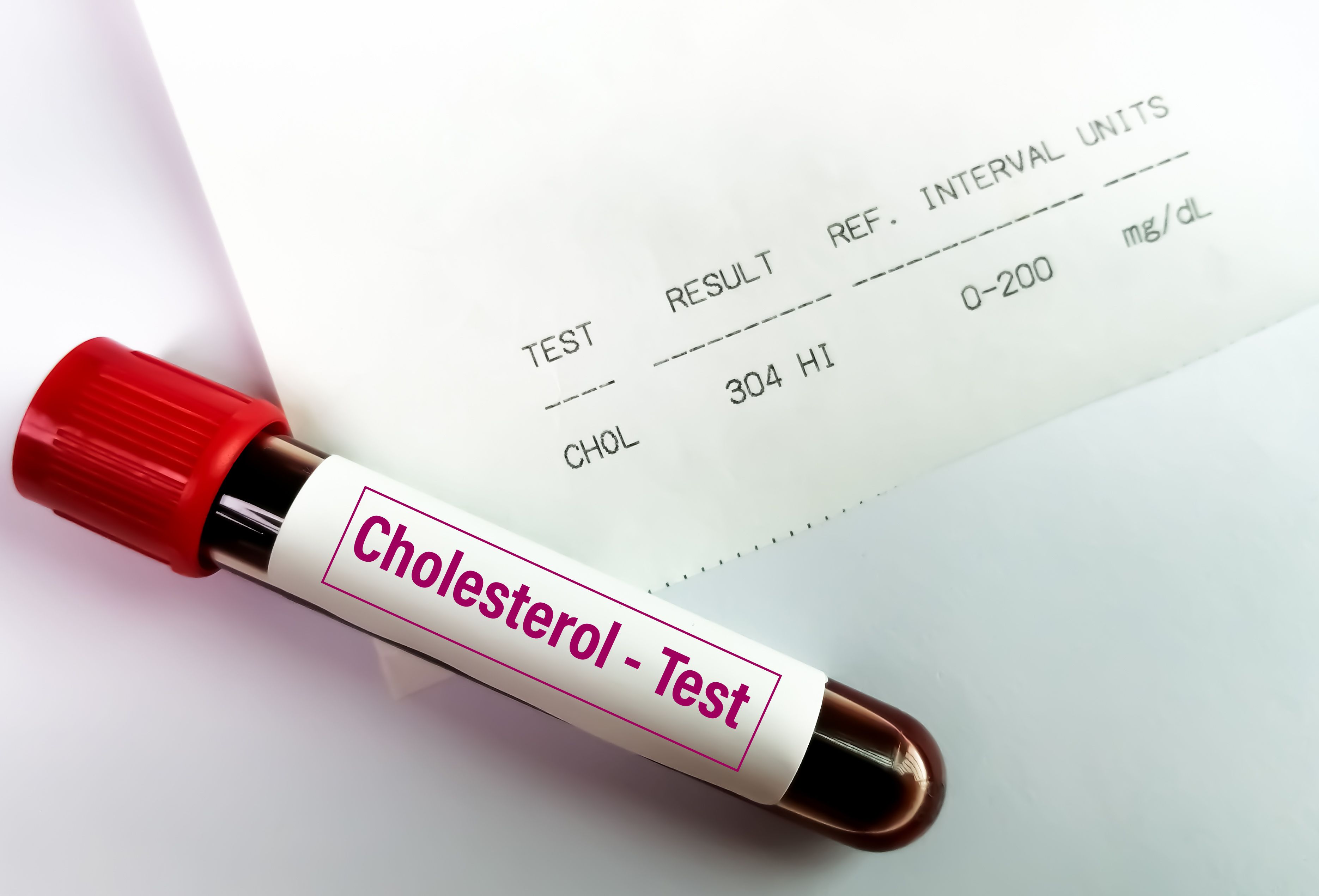 Glaucoma, Cholesterol, Lipid | Image Credit: © Saiful52 | stock.adobe.com