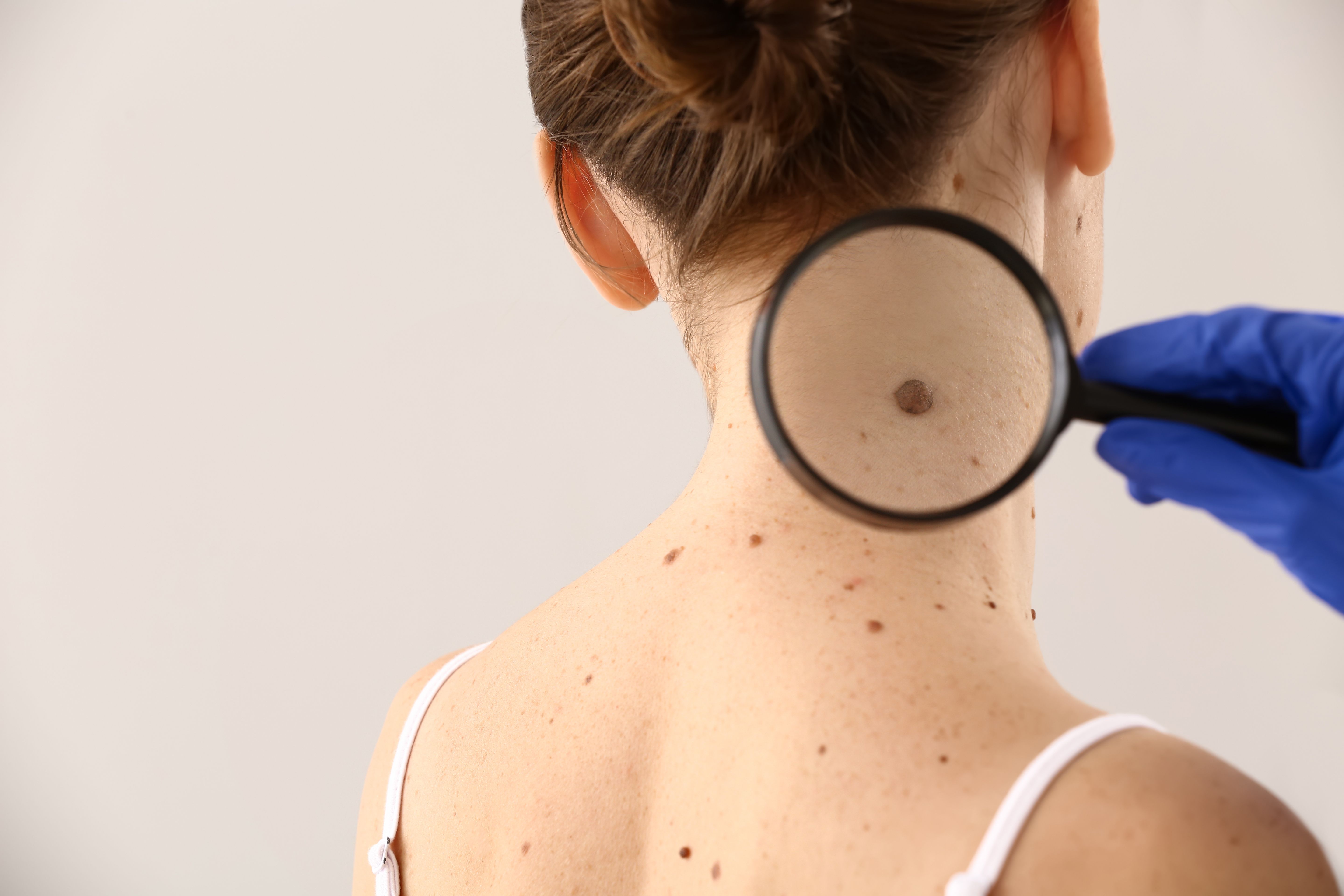 Patient being checked for melanoma -- Image credit: Pixel-Shot | stock.adobe.com