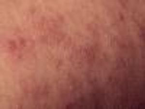 Study Validates Interleukin-17A Efficacy Against Psoriatic Arthritis