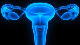 Expert: Consider Dose Intensity With PARP Inhibitors for Ovarian Cancer