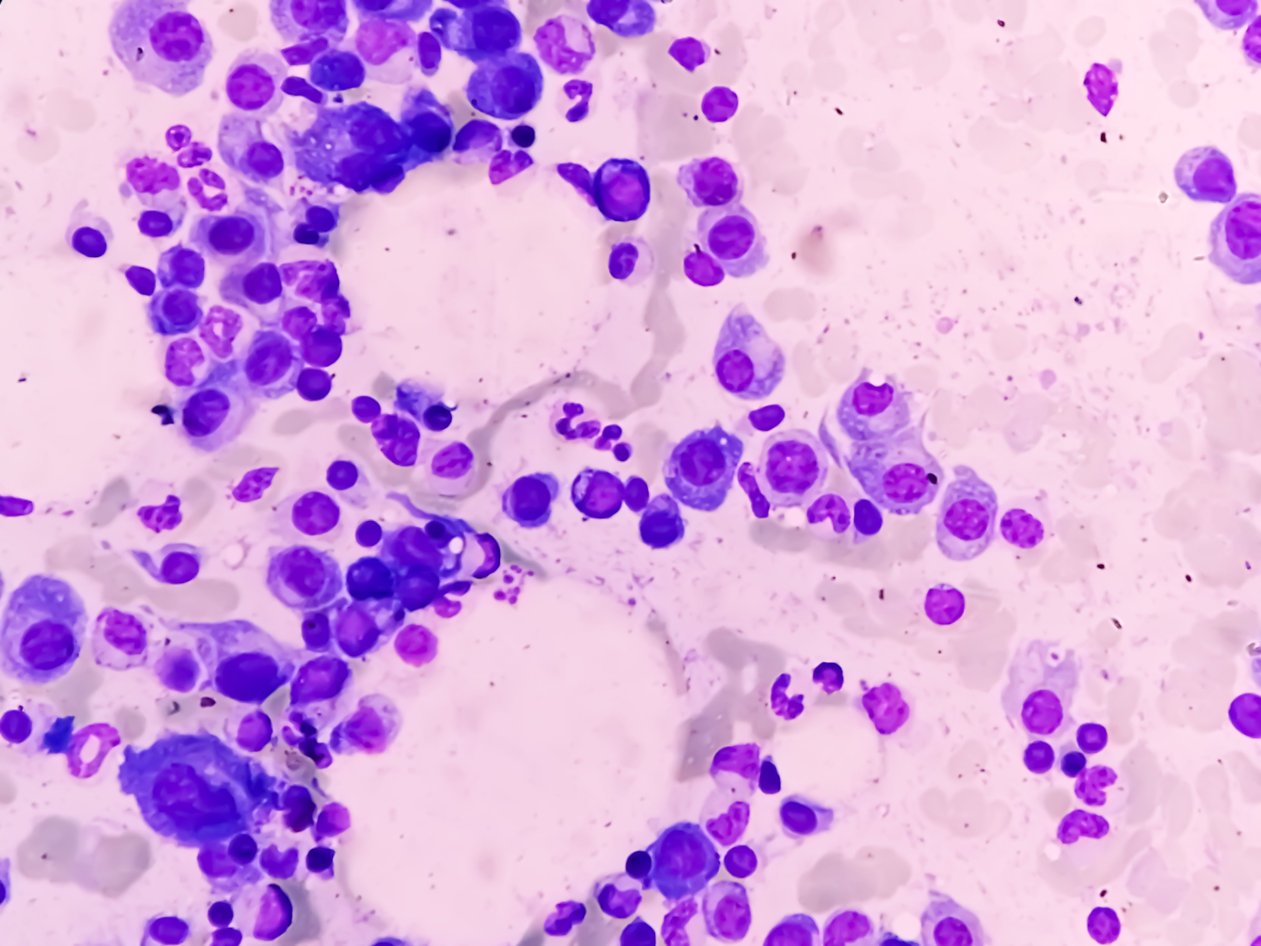 Multiple myeloma in bone marrow -- Image credit: Saiful52 | stock.adobe.com