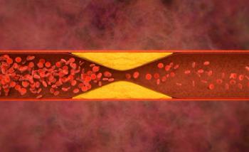Atherosclerosis with cholesterol blood or plaque in vessel cause of coronary artery disease