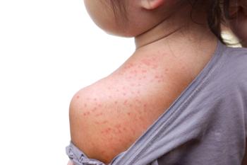 Child with measles rash | Image Credit: © weerapat1003 - stock.adobe.com