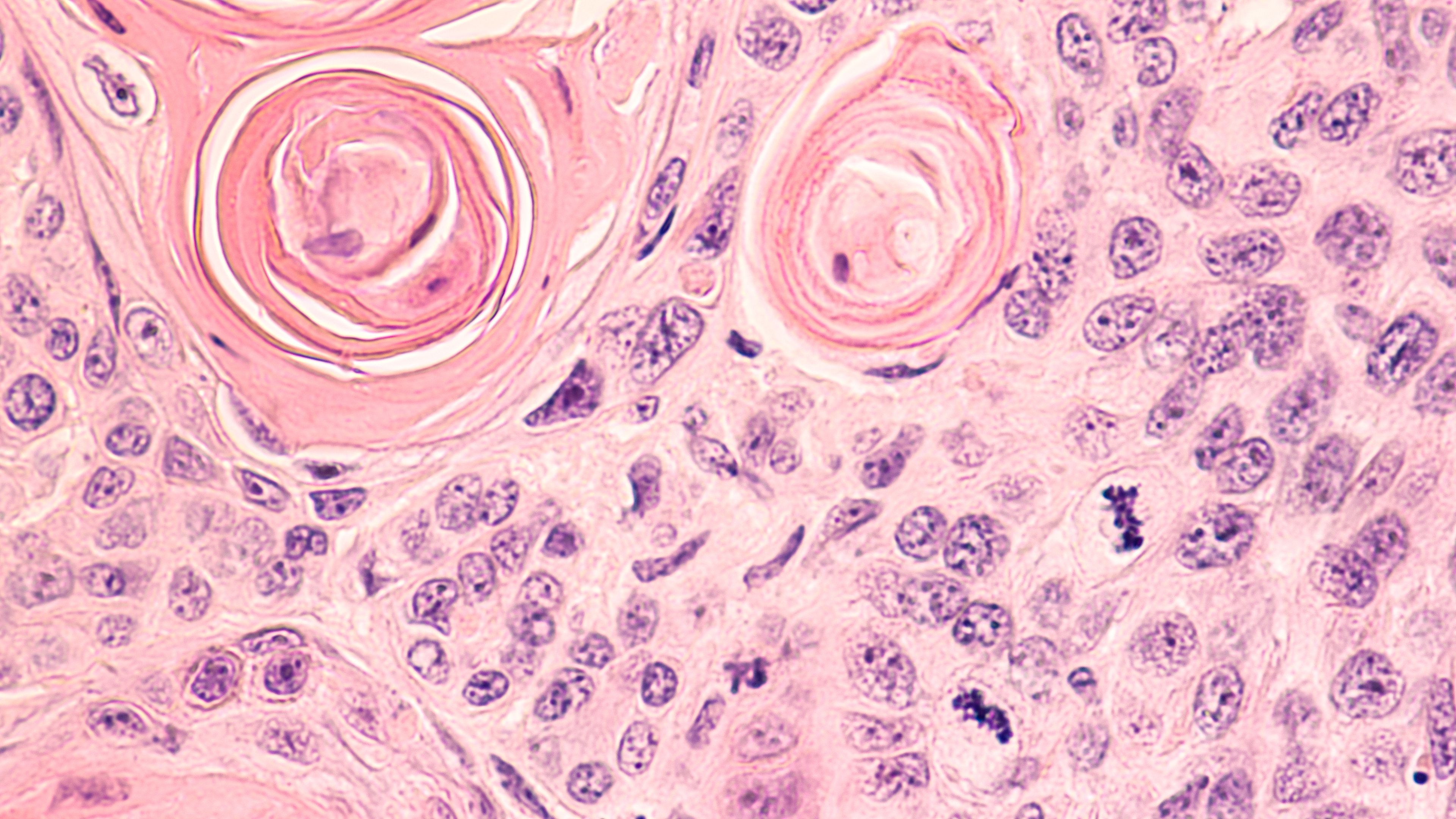 Non–small cell lung cancer (NSCLC) -- Image credit: David A Litman | stock.adobe.com