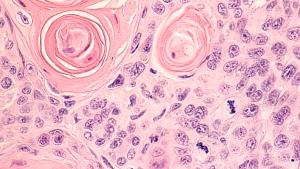 Non–small cell lung cancer (NSCLC) -- Image credit: David A Litman | stock.adobe.com