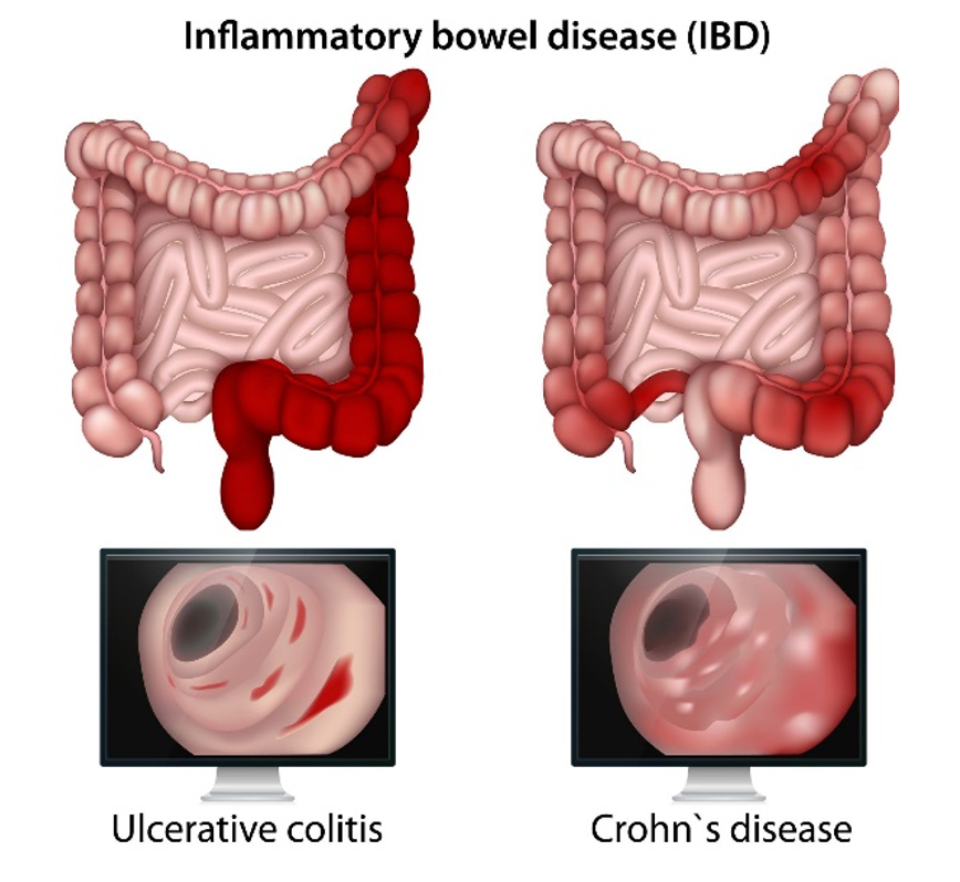 Pharmacy Clinical Pearl of the Day: Crohn Disease vs Ulcerative Colitis | Pharmacy Times Pharmacy Clinical Pearl of the Day: Crohn Disease vs Ulcerative Colitis | Pharmacy Times