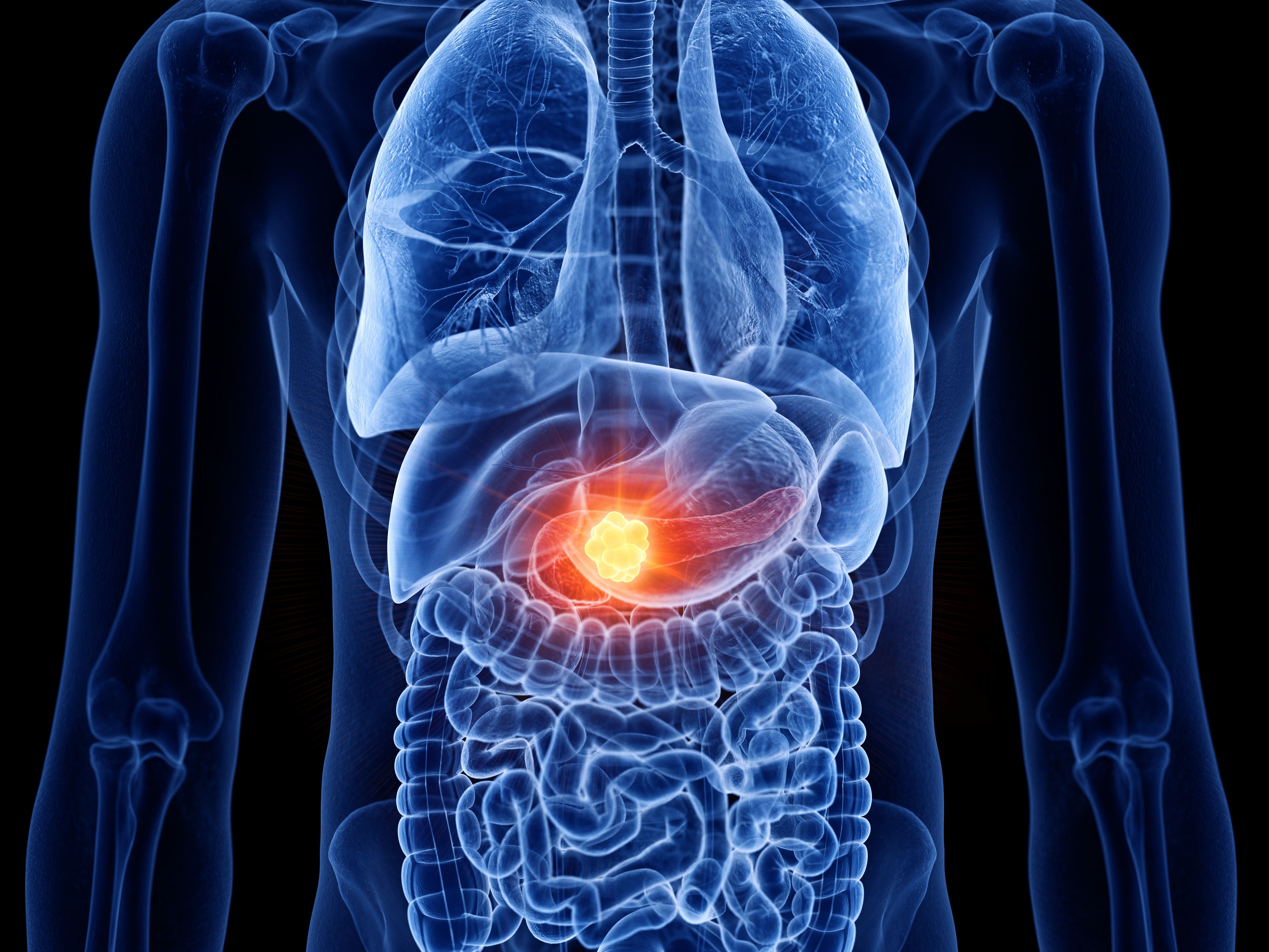 3d rendered medically accurate illustration of pancreas cancer - Image credit: Sebastian Kaulitzki | stock.adobe.com