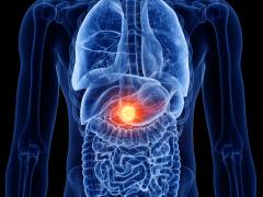 3d rendered medically accurate illustration of pancreas cancer | Image Credit: Sebastian Kaulitzki | stock.adobe.com