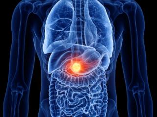 3d rendered medically accurate illustration of pancreas cancer | Image Credit: Sebastian Kaulitzki | stock.adobe.com