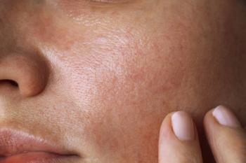 pores on the skin of the face. Cleansing the face skin - Image credit: Angelina | stock.adobe.com