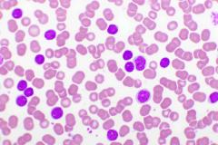 EP. 13 Experts Outline Best Practices in the Treatment of Chronic Lymphocytic Leukemia