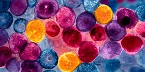 Peripheral blood smear analysis for acute leukemia using 100x light microscopy | Image Credit: © Selvam - stock.adobe.com