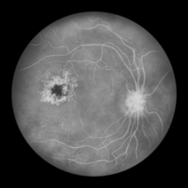 Macular edema following RVO -- Image credit: Dr_Microbe | stock.adobe.com