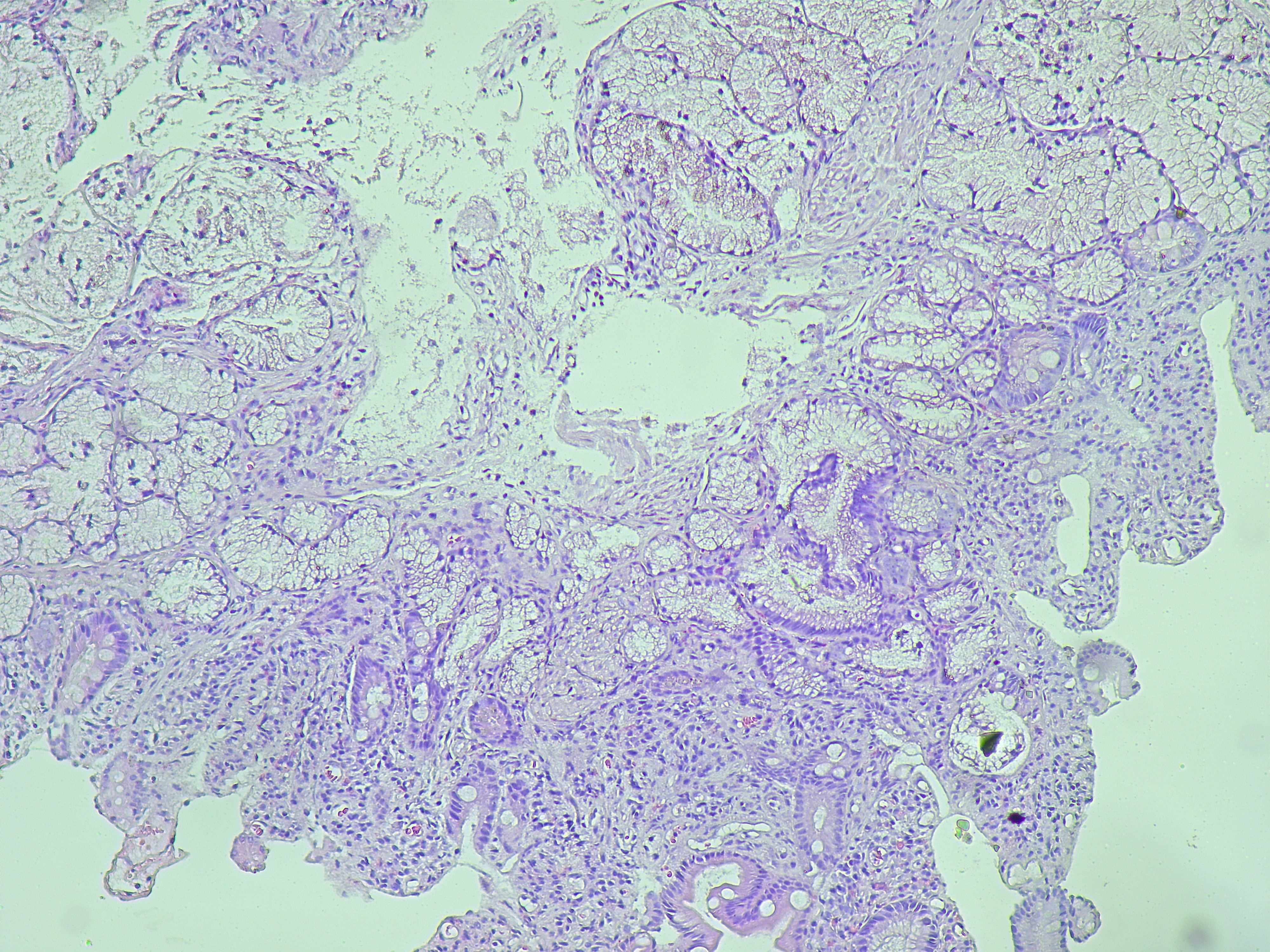 AACR 2025: Tailored Treatment Guided by Combined Tissue and Liquid Biopsies May Improve Outcomes in Advanced Solid Tumors