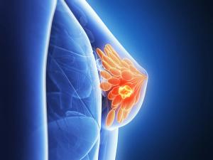 Breast cancer -- Image credit: Sebastian Kaulitzki | stock.adobe.com