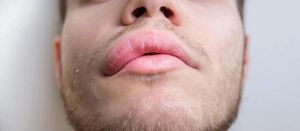 Hereditary Angioedema: The Pharmacist's Role in Team-Based Patient Care