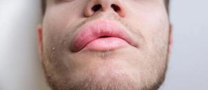 Hereditary Angioedema: The Pharmacist's Role in Team-Based Patient Care