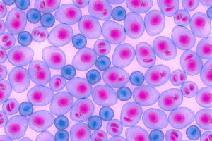 Multiple Myeloma multiplex leukemia cancer 3d color render illustration | Image Credit: © LASZLO - stock.adobe.com 
