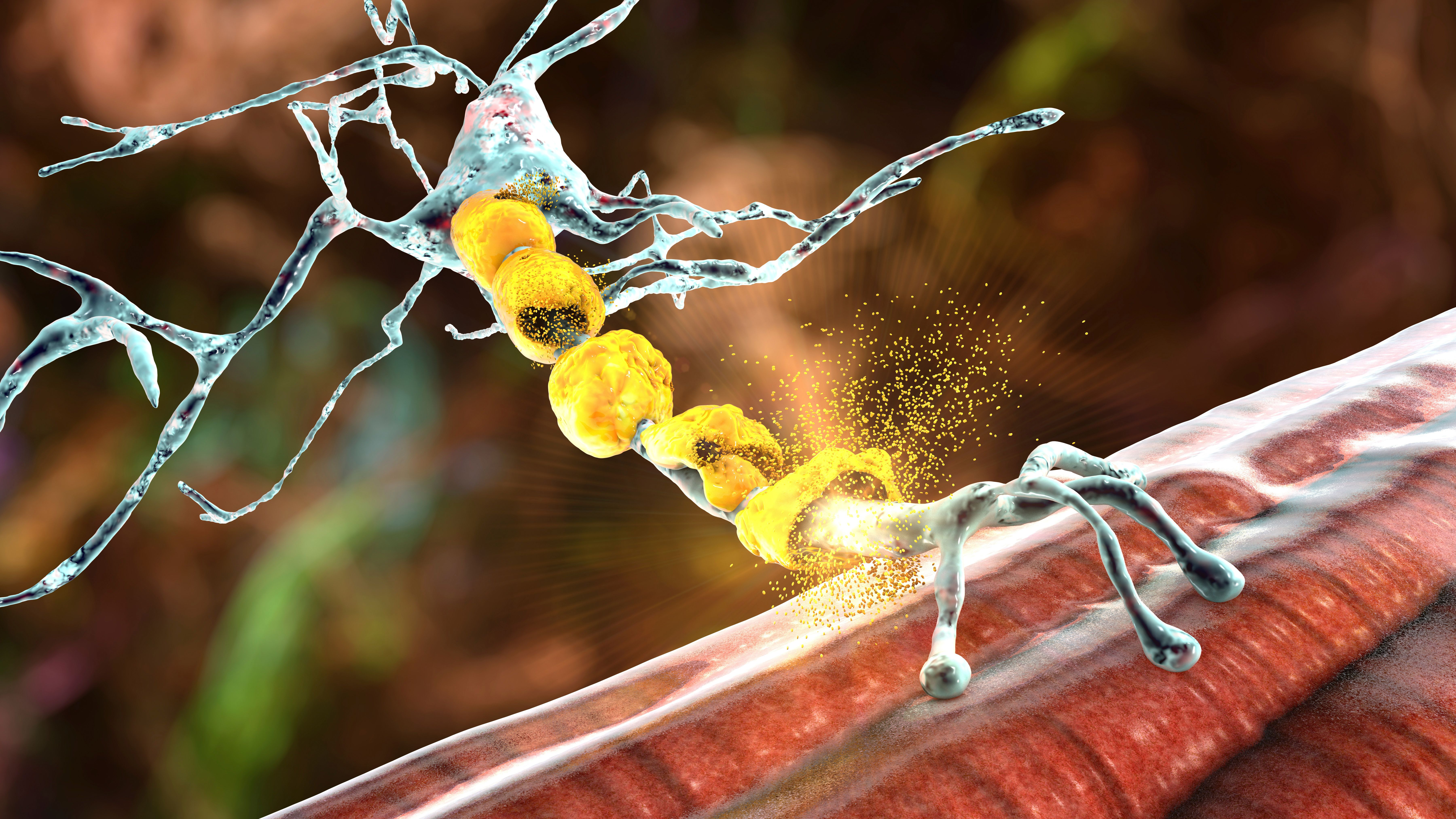 Damage of the neuron myelin sheath seen in demyelinating diseases