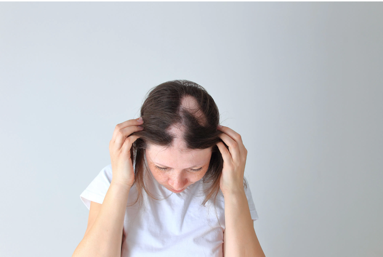 Topikal minoksidil, kemoterapiye bağlı alopesisi olan pediatrik hastaların %87'sinde saç büyümesini iyileştirir.