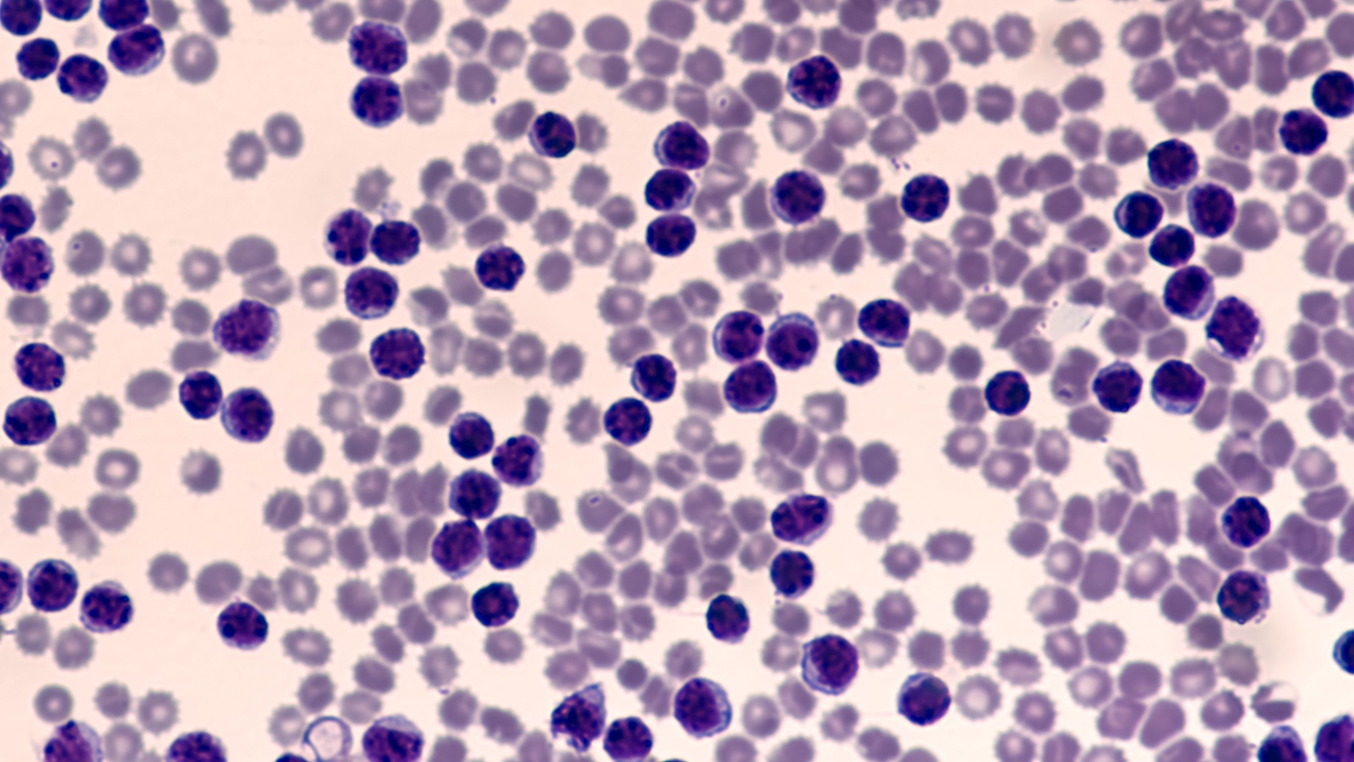 Leukemia Awareness: Photomicrograph of pleural effusion in a patient with chronic lymphocytic leukemia (CLL), which is the same disease as small lymphcytic lymphoma (SLL), a cancer of lymphcytes.