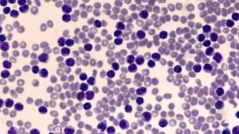Leukemia Awareness: Photomicrograph of pleural effusion in a patient with chronic lymphocytic leukemia (CLL), which is the same disease as small lymphcytic lymphoma (SLL), a cancer of lymphcytes.