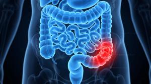 Target Trial Emulation Finds Limited Survival Benefit With Statins After Colorectal Cancer Treatment