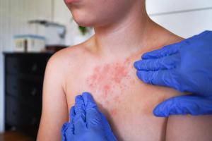 FDA Approves Risankizumab for Pediatric Plaque Psoriasis, Psoriatic Arthritis