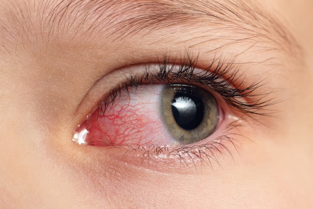 Closeup irritated infected red bloodshot eyes, conjunctivitis