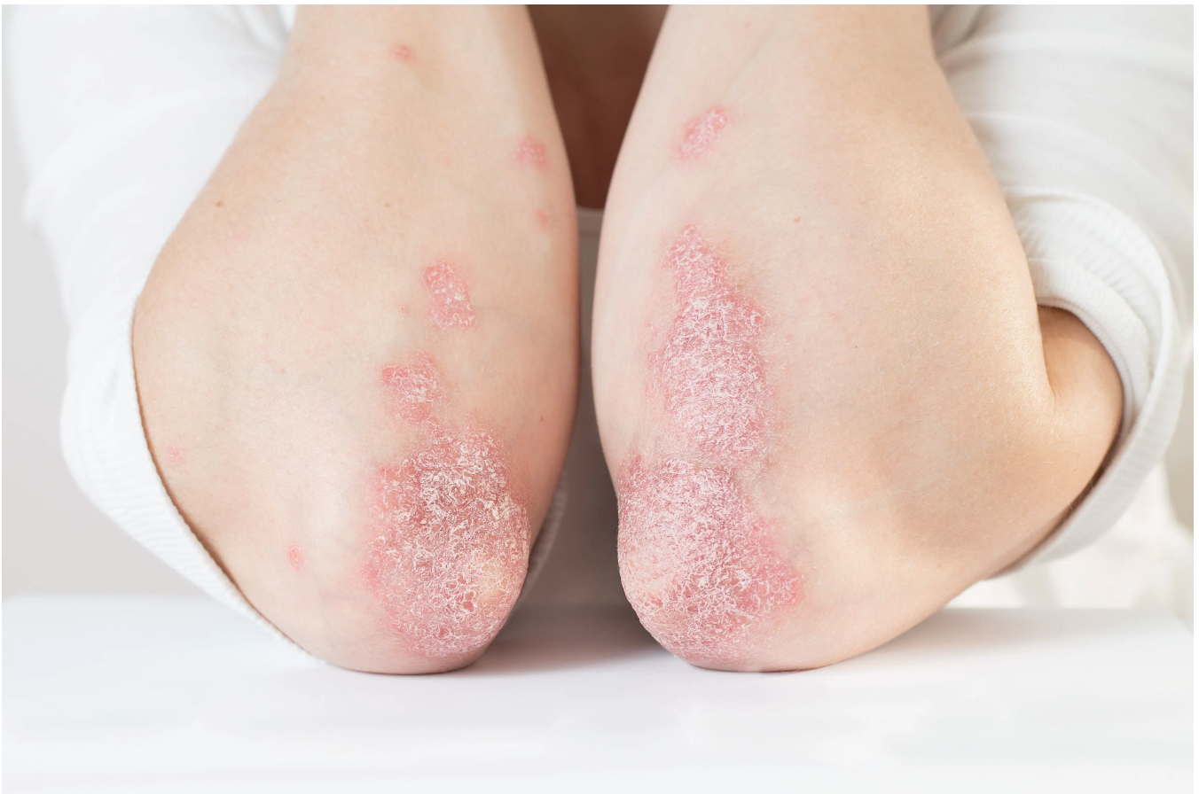 Upadacitinib Can Significantly Improve Clinical Outcomes in Patients With Atopic Dermatitis - Vimarsana News