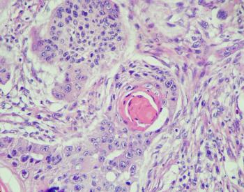 Renal Cell Carcinoma | Image Credit: Chutima - stock.adobe.com