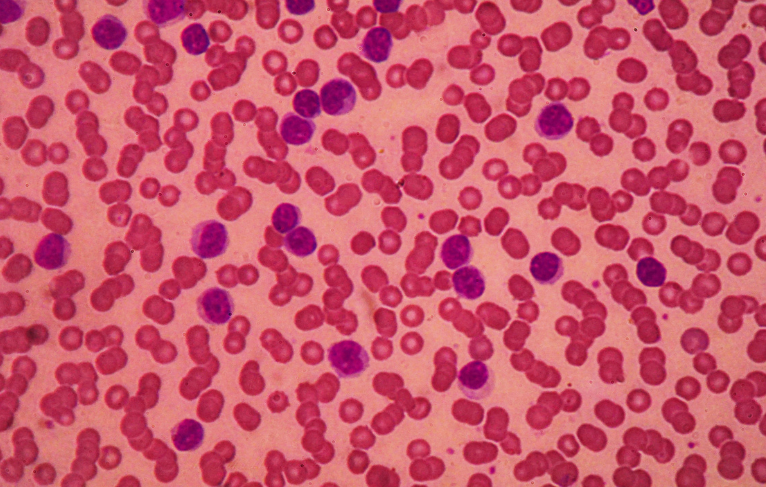 New Data Reinforce the Long-Term Benefit of Venetoclax-Based Combination for People With Relapsed/Refractory CLL