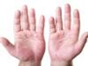 Taltz Gets FDA Approval for Psoriatic Arthritis