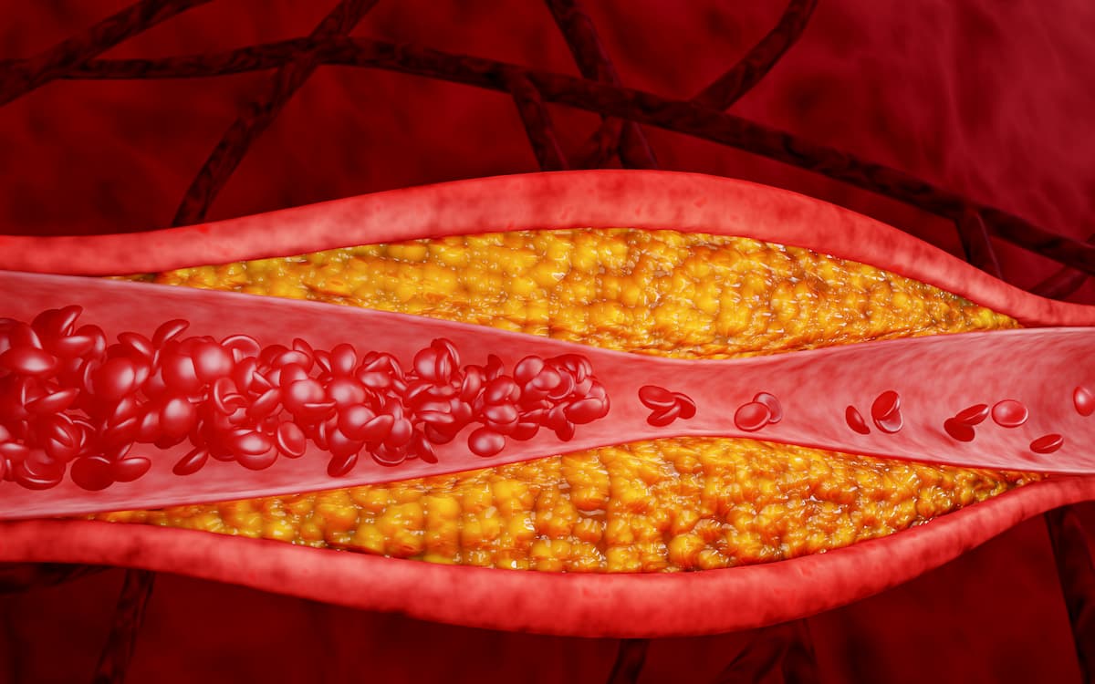 Clogged arteries, Cholesterol plaque in the artery