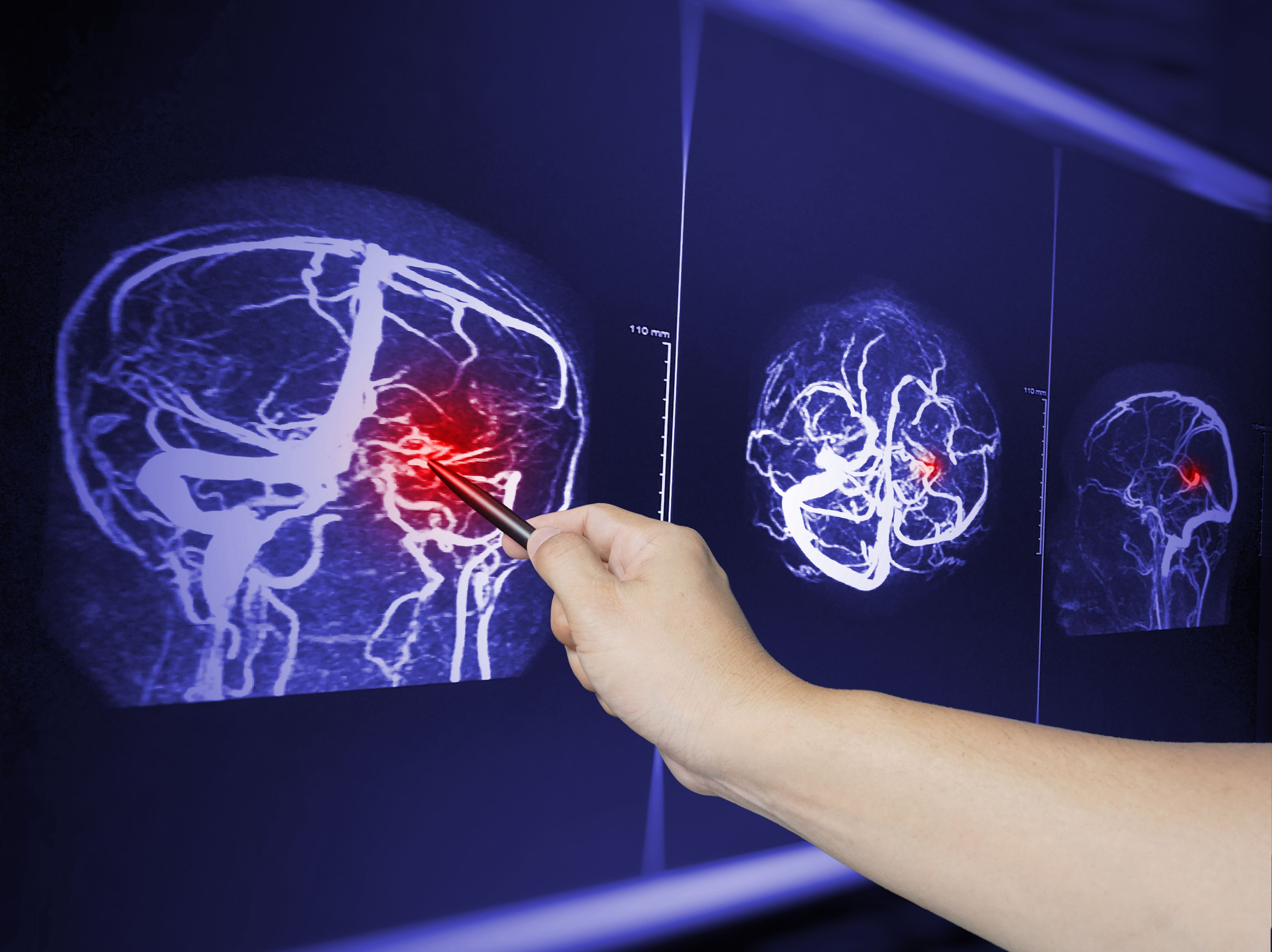 Close up Hand doctor point MRA brian scan image of a recent traumatic brain injury patient showing brain contusion and hemorrhage.Medical image concept. | Image Credit: Richman Photo | stock.adobe.com 