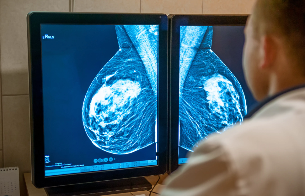 Expert presents Updates in Early-Stage Breast Cancer from the HOPA 2023 Annual Conference. Credit: okrasiuk - stock.adobe.com.