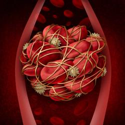 Acalabrutinib Demonstrated Fewer Incidences of Atrial Fibrillation Versus Ibrutinib in Previously Treated Patients With Chronic Lymphocytic Leukemia