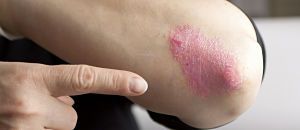 Pharmacists Reaching Out: The Pharmacist Role in Management of Psoriasis and Psoriatic Arthritis