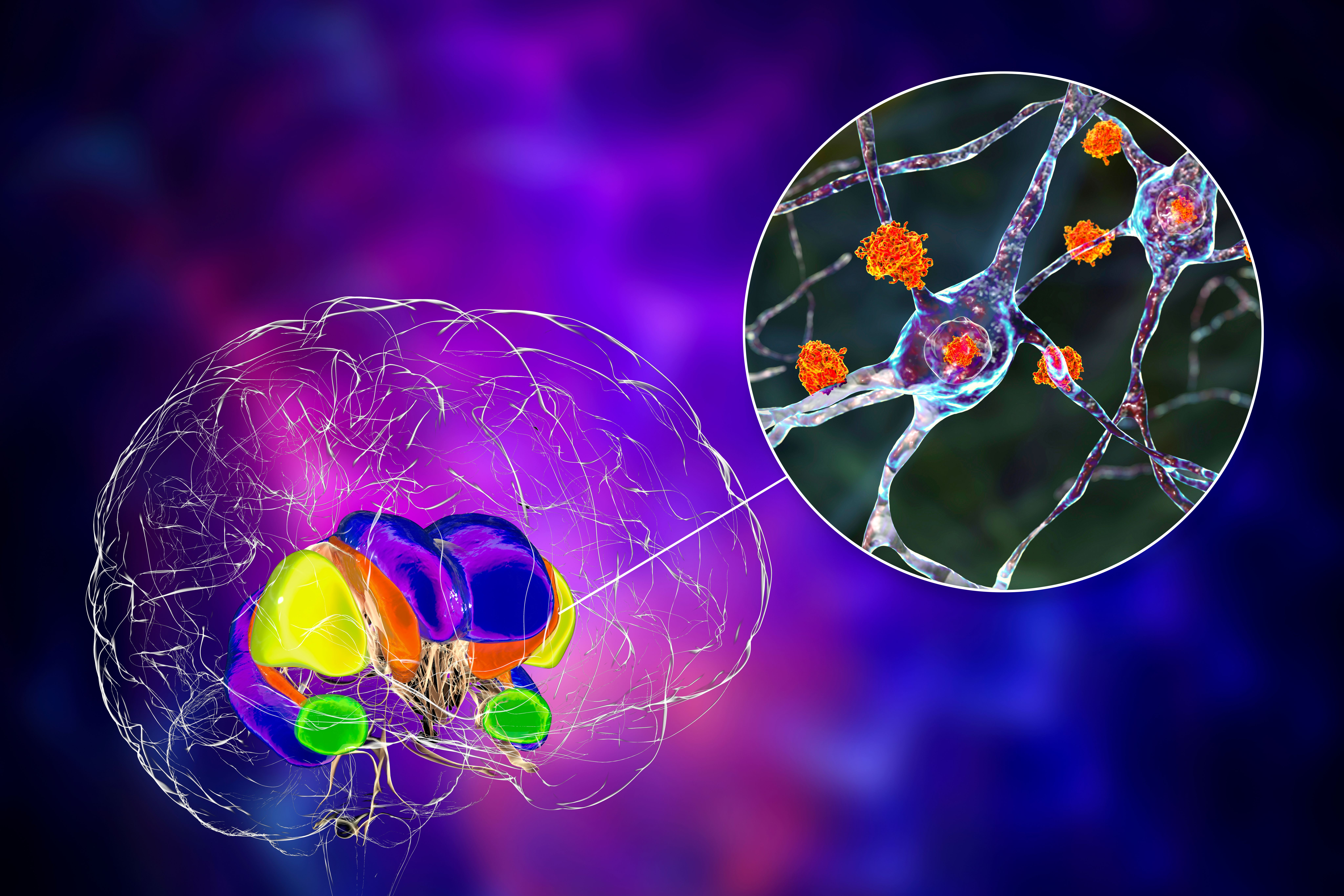 Huntington disease -- Image credit: Dr_Microbe | stock.adobe.com