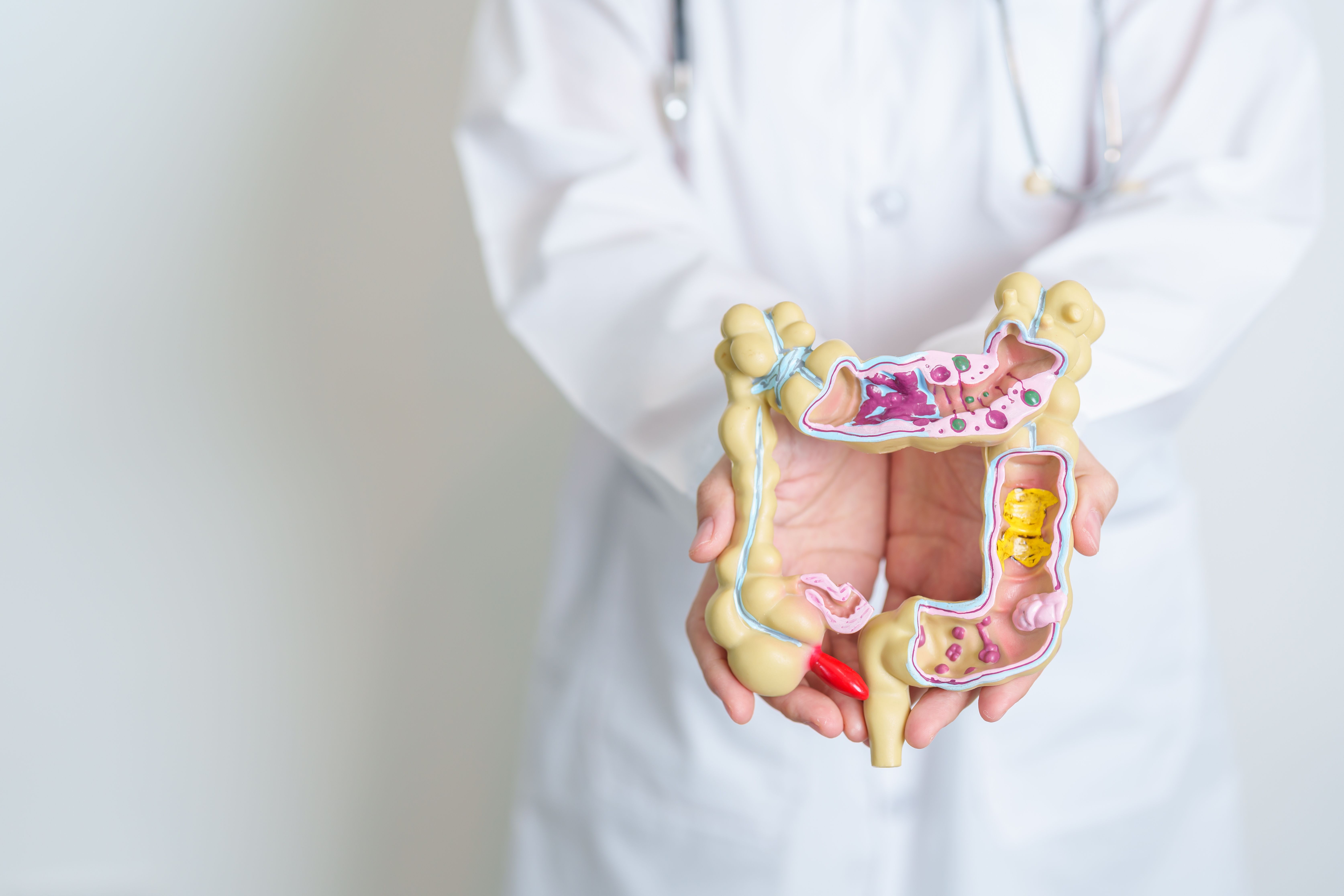 Model of digestive tract with Crohn disease -- Image credit: Jo Panuwat D | stock.adobe.com