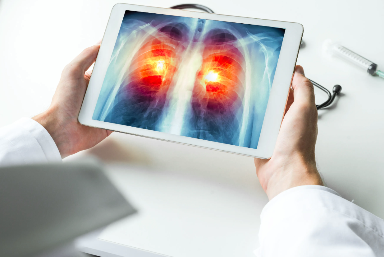 Pharmacists' Involvement in Treatment Decisions for NSCLC Has Increased and Evolved - Vimarsana News